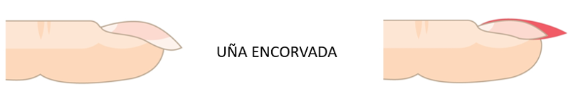 corregir uñas irregulares