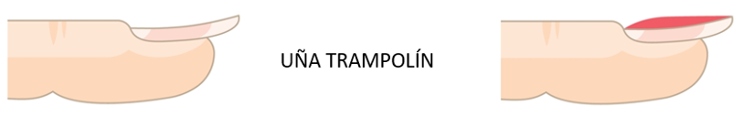 Primer plano de una uña trampolín con curvatura anormal hacia arriba, mostrando la lámina ungueal levantada.