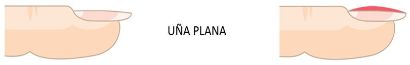Primer plano de una uña plana con superficie lisa y sin curvatura