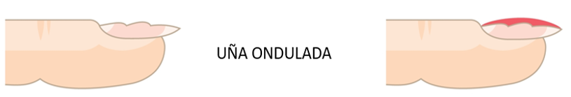 Primer plano de una uña ondulada con superficie irregular y líneas visibles